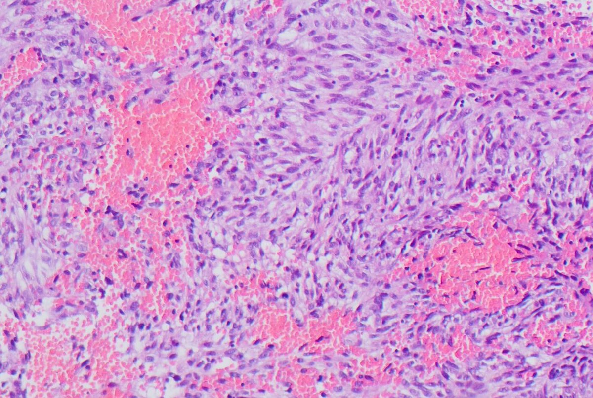 ISGyP164.3: 57 years female,Cervical mass ?fibroid.Diagnosis: NTRK sarcoma. PanTRK positive on IHC and NTRK3 rearrangement on FISH.A unique fibrosarcoma-like tumour of the uterine cervix harbouring a rearrangement of a neurotrophic tyrosine kinase receptor gene (NTRK1 or NTRK3)