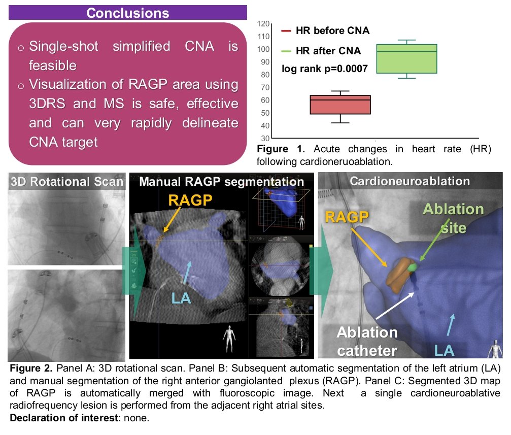 We're now down to 30 seconds of radiofrequency with 20-25 Watts for the majority (>90%) of all our #CNA cases targeting the right anterior GP. Peri-procedural 3D reconstruction of the ablation target allows to minimize the ablation lesion set #EHRA2024 🎯