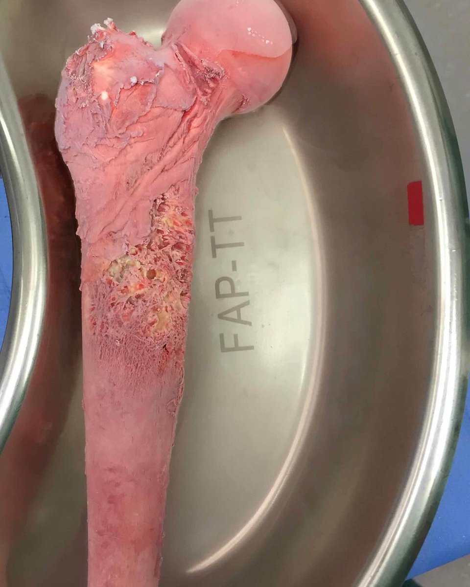 🦴 This is the femur of a 10-year-old boy with Ewing’s Sarcoma after treatment with liquid nitrogen.