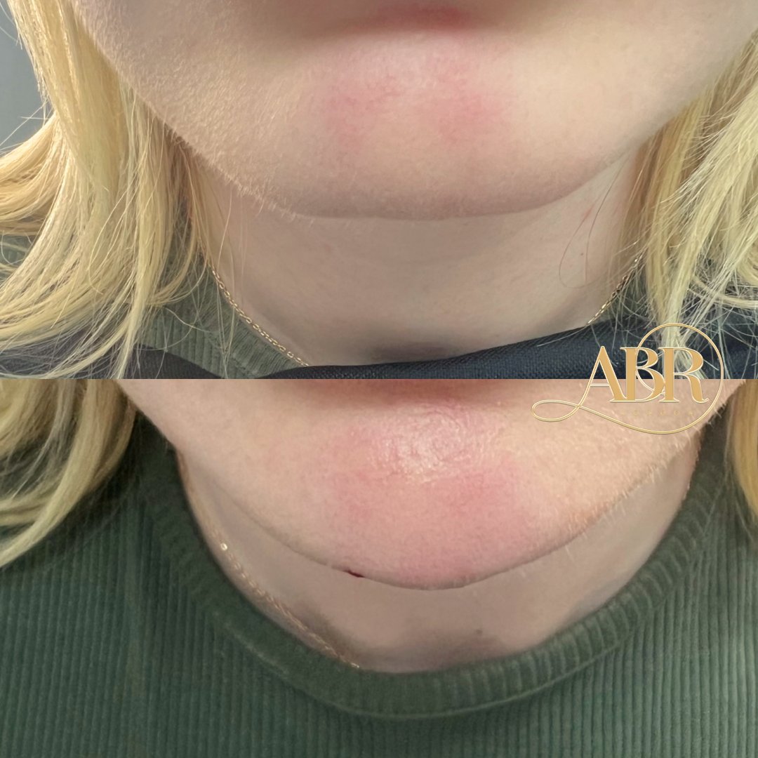 𝗖𝗛𝗜𝗡 𝗚𝗢𝗔𝗟𝗦 👀 

We brought the SHAPE to our clients Chin with a slight tweakment to not only elongate but also round out the Chin 💉  

#londonaesthetics