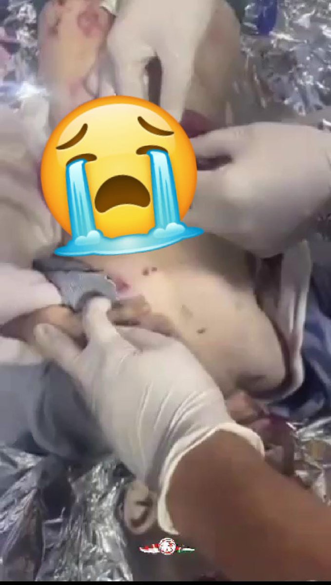 Serangan udara Israel telah mengakibatkan usus anak kecil ini keluar dari tubuhnya; saat ini dia sedang mendapatkan perawatan untuk menyelamatkan nyawanya

#FreePalaestine 🇵🇸
#ısraelTerrorists
#SavechildGaza 
#SahabatPalestina_ID