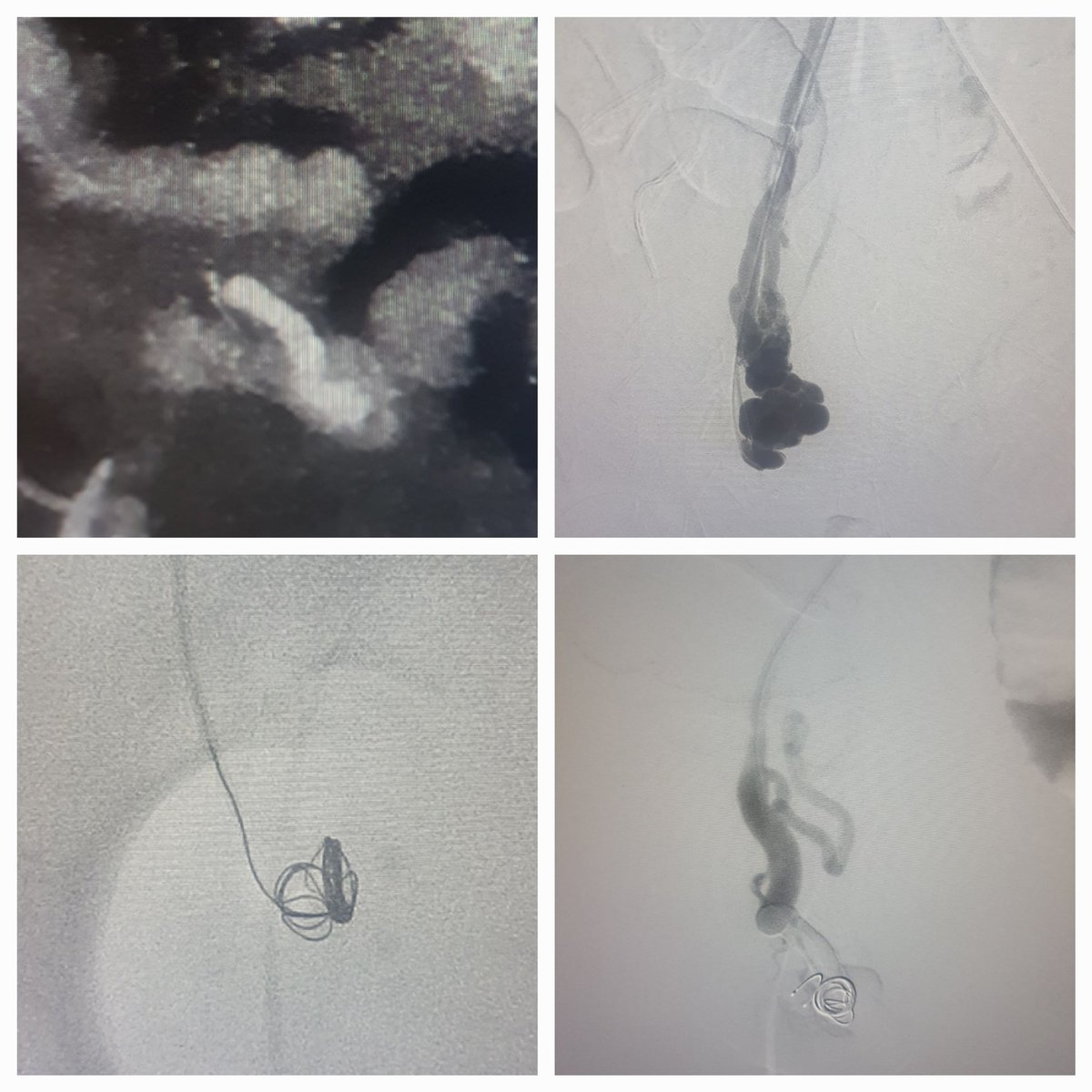 Dr Saurabh kumar Interventional radiologist tweet media