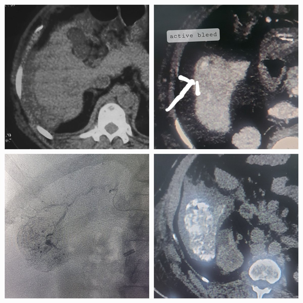 Dr Saurabh kumar Interventional radiologist tweet media