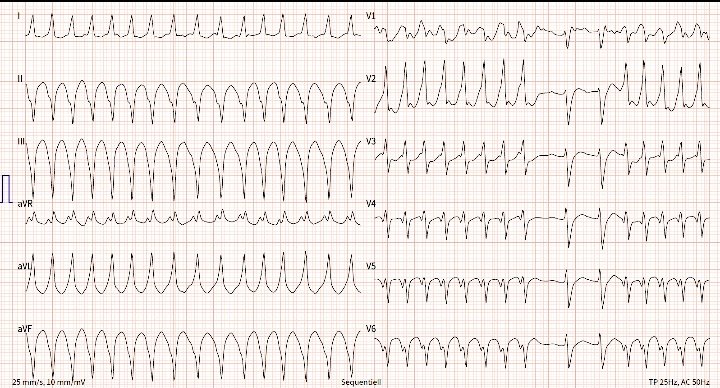 Palpitation,syncope , absent pulse,
 What is Diagnosis ⁉️