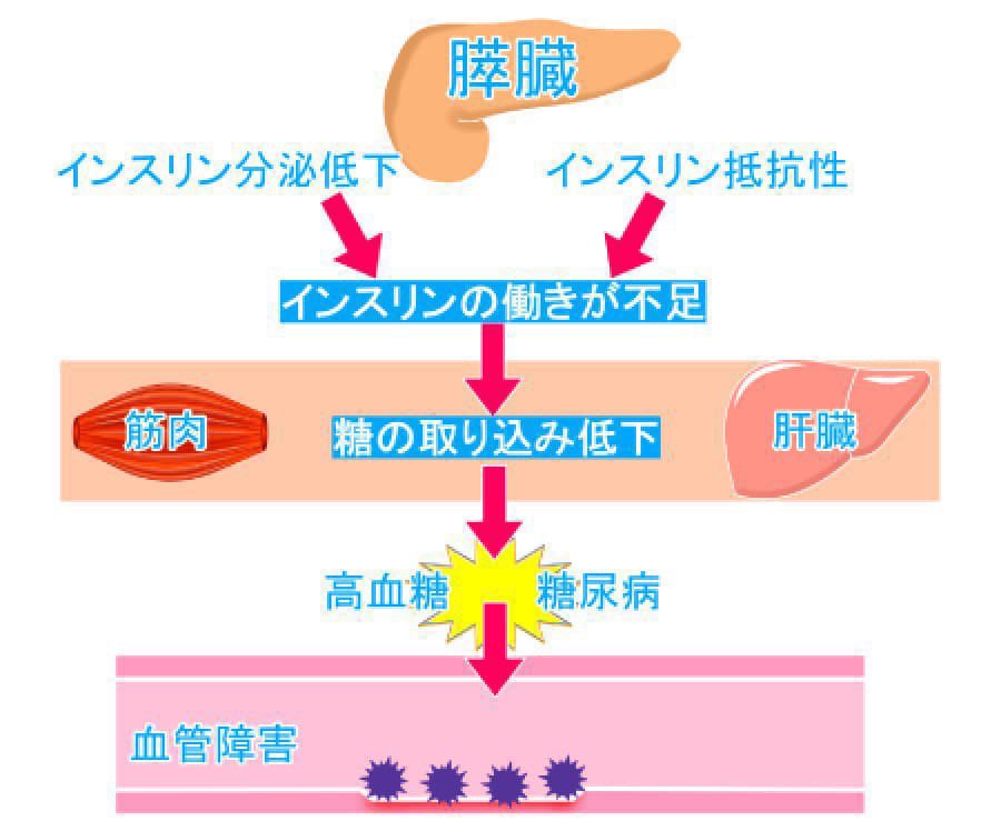To_nyo_DM's tweet photo. ◎糖尿病の原因

✅筋肉の『血糖を取り込む量の減少』が大きな要因※高血糖状態

👉内蔵脂肪が増えることで『筋肉の血糖を取り込む力を低下させる』分泌物が増えるため※アディポサイトカイン

👉高血糖は毛細血管に付着してダメージを与える(糖化)ことで『腎機能低下・失目・神経障害』等を誘発する https://t.co/cfltw04eKD
