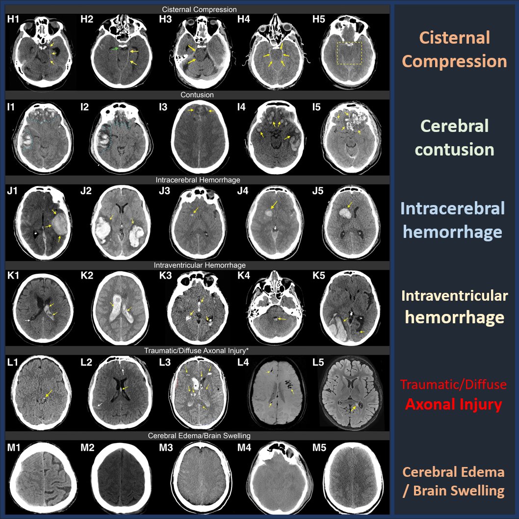 Part 2 of a very nice pictorial overview of the spectrum of imaging findings in traumatic brain injury by @t_vandevyvere, check out the complete article here: liebertpub.com/doi/10.1089/ne… #neurorad #radres #MedEd #FOAMed #radiology