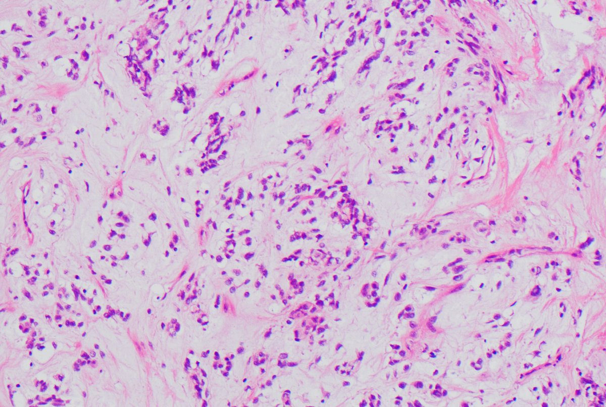 ISGyP 164.6: 36 year old female with an enlarging fibroid uterus.  On macroscopic examination, there is a dominant mesenchymal lesion 12.5cm with a myxoid and nodular cut surface.
 Diagnosis: Fusion related sarcoma: CDC42 – PLAG1 fusion transcript, has been identified.