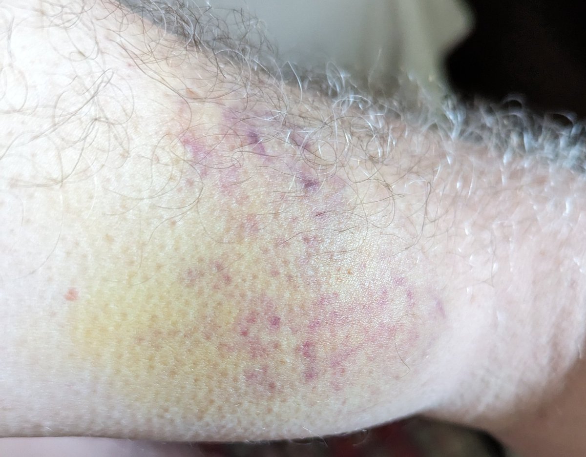 I had a trip and near fall in Alnwick last Tuesday. Just managed to reach out and 'grab' an ornamental lamppost with my elbow pit (spinning ungracefully around the post), but it was quite quick and hard an impact. Now proven as the bruise emerges! 🫣