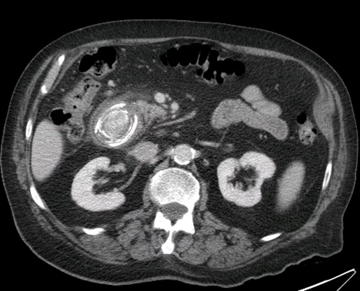 An elderly patient with acute abdominal pain, elevated liver tests, nausea and now continuous vomiting

What is your diagnosis?

Reply below with your answer and I will Auto-DM you the correct answer.