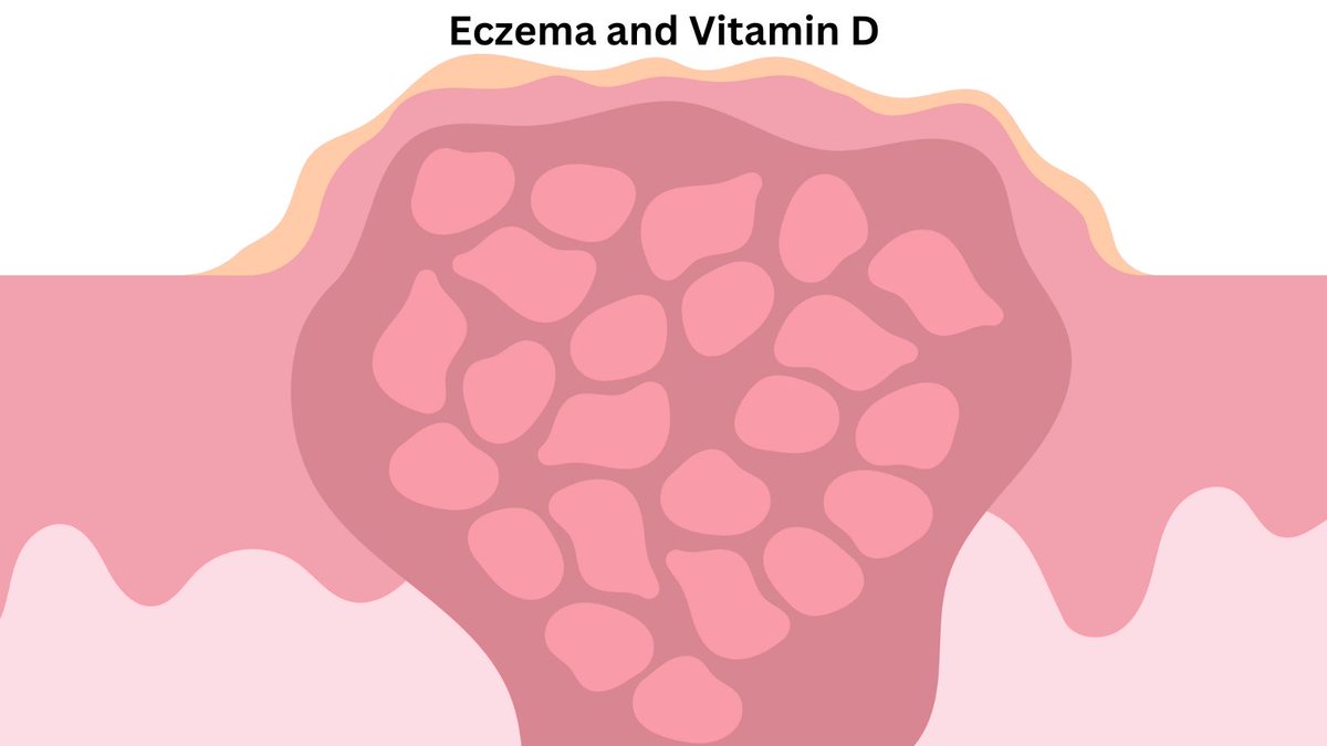 New research shows that maternal vitamin D status is strongly related to the odds of getting early and persistent eczema for the child. This isn't too surprising because vitamin D helps regulate all aspects of immune function. Eczema is also related to gut health issues and…