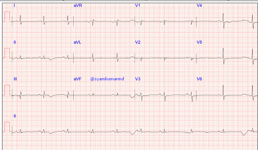 What do you see here? For medical students and ECG enthusiasts 
#ECG #FOAMed #MedTwitter