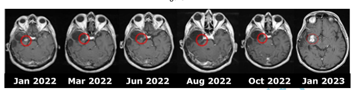 ⭐️Picking that needle in haystack --> ROS1 fusion in Glioblastoma. 👉Striking response to entrectinib in glioblastoma harboring ROS1 fusion - nice work by @DrLombardiGiu @martapdn @iov_irccs et al 🎯🧬🇮🇹@EANOassociation @NeuroOnc #glioblastoma #precisionmedicine @oncodaily…