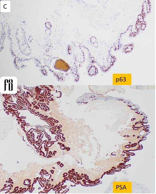 👉71 YO male with urinary bladder mass. [A] is section from the mass. [B] was an incidental finding among the tumor. [C] demonstrates IHC done in that area. PAX8 was negative. What is the diagnosis as seen in A? What is B? Courtesy @annsmiley78 #PathTwitter #GUpath