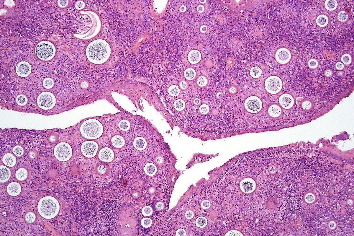 Incredible example of a rare disease! Nasal polyp. Pic by Dr. Phillip McKee @phmckee1948. Your diagnosis? Answer & More amazing pics of this entity (from a different case): kikoxp.com/posts/5703. #dermpath #ENTpath #IDpath #pathologists #pathology #pathTwitter
