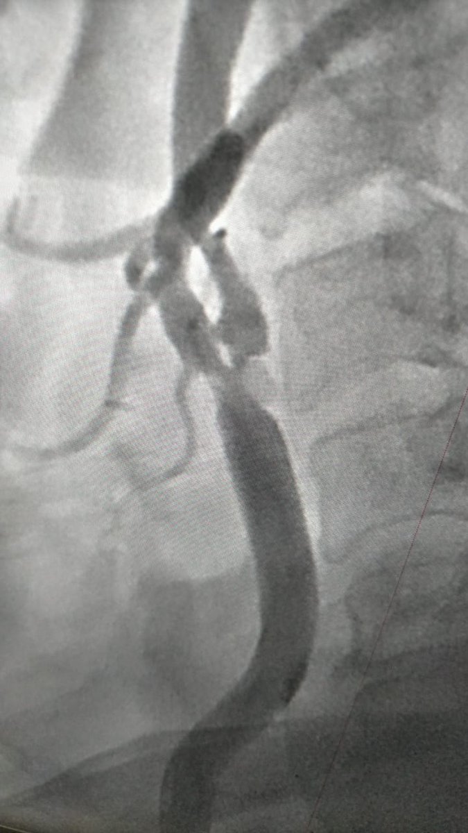 Post CABG , DM, HTN , recurrent syncope. What's your approach @mmamas1973 @WomenAs1 @mirvatalasnag @aymanka @stefan_harb @RameshDaggubati @aymanka @PCRonline #CardioTwitter @FlavioRibichini @GoranEBC @mirvatalasnag @SVRaoMD @Drroxmehran @crfheart @drsonyaburgess @ditchhaporia