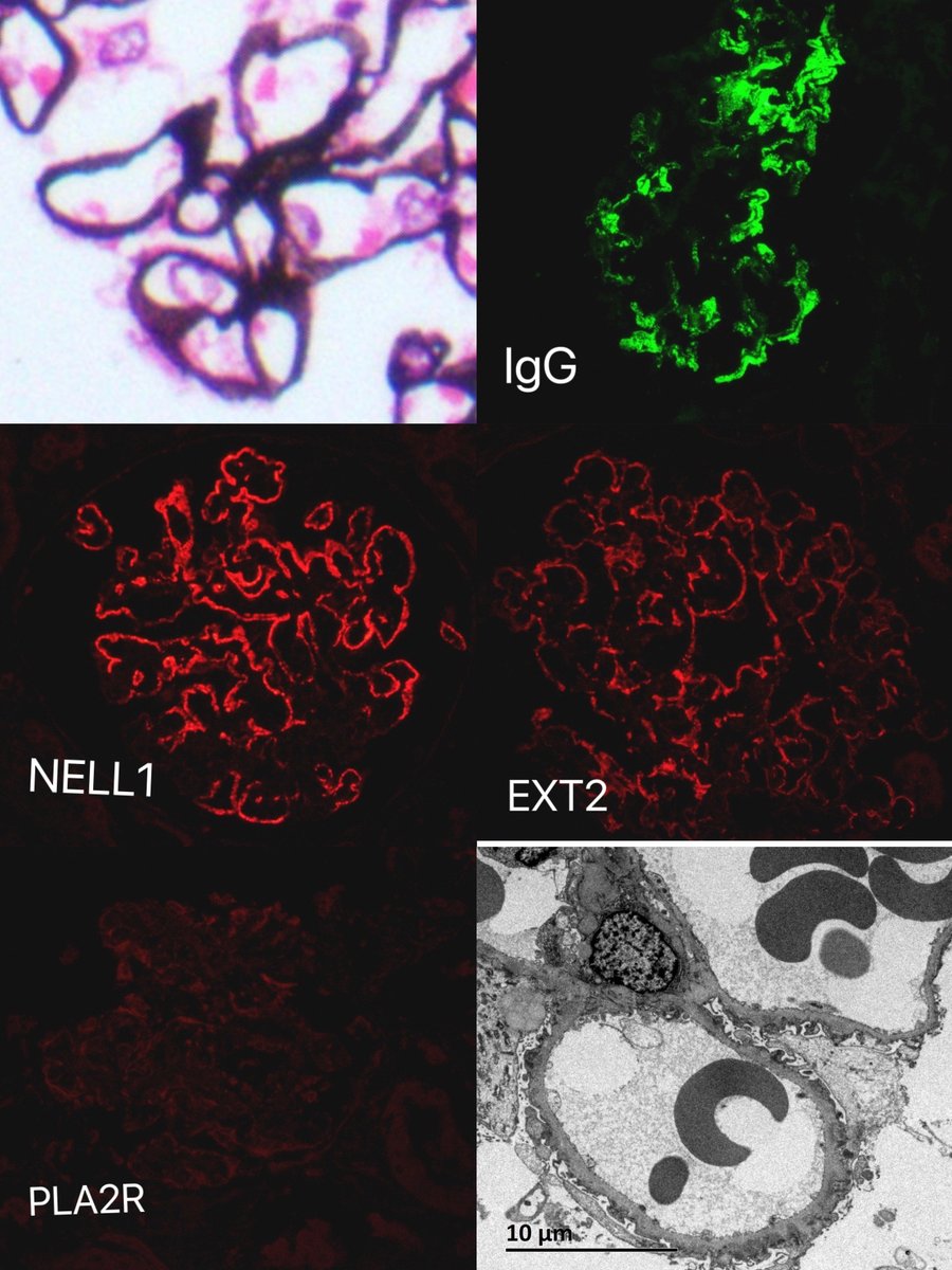 31yrs，female，no hints of CTD except ANA1:1000, LM, EM and IgG existed as segmental MN, with both NELL1 and EXT2 positivity. PLA2R was negative.