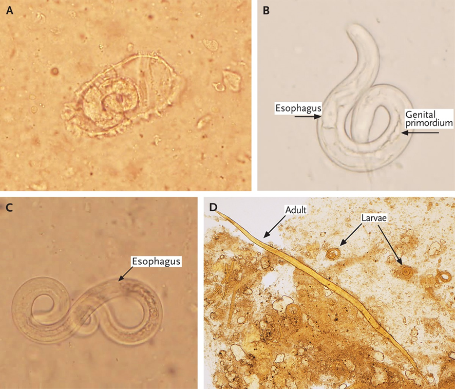 65 años vietnamita, glucocorticoides (arteritis de células gigantes), bacteriemias por BGN: duodenitis 
🔬bronquial: huevos embrionados (A), larvas rabditoides (B) y filariformes móviles (C)
🔬heces, larvas rabditoides y formas adultas (D)
½

DOI: 10.1056/NEJMicm1204579
#IDXposts