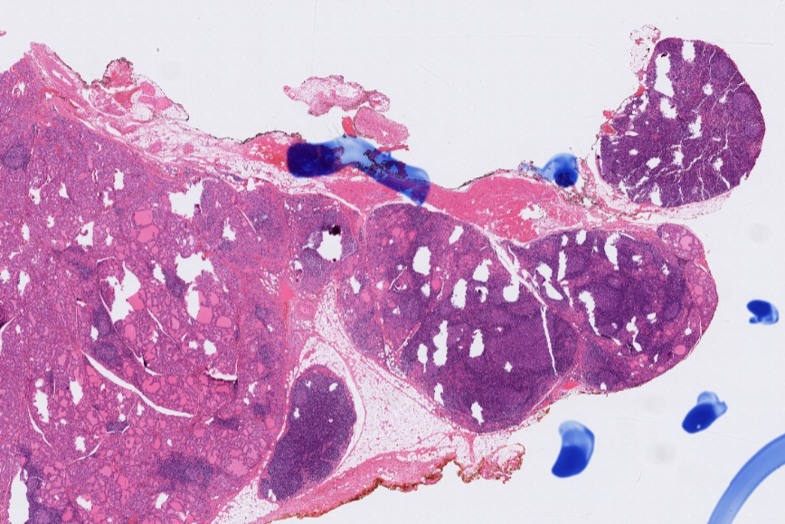 #Everydaythyroid Posterior thyroid-NORMAL FINDINGS -The capsule is deficient and thyroid is close to the muscle -You can have deposits of thyroid gland embedded in skeletal muscle Dr. Baloch #USCAP2024 #pathologists #pathology #PathX #PathTwitter #pathresidents #NIPPathX
