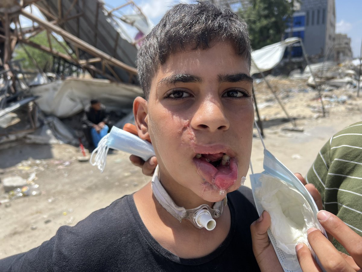 Being a journalist is a burden as people thinks we can help. His father approached me near Al Ahly Al Araby Hospital in #Gaza_Square and asked to report his story wishing someone would help evacuating his son from #Gaza! 🗣️Majd al Shaghnoubi, 13, has been wounded in his jaw