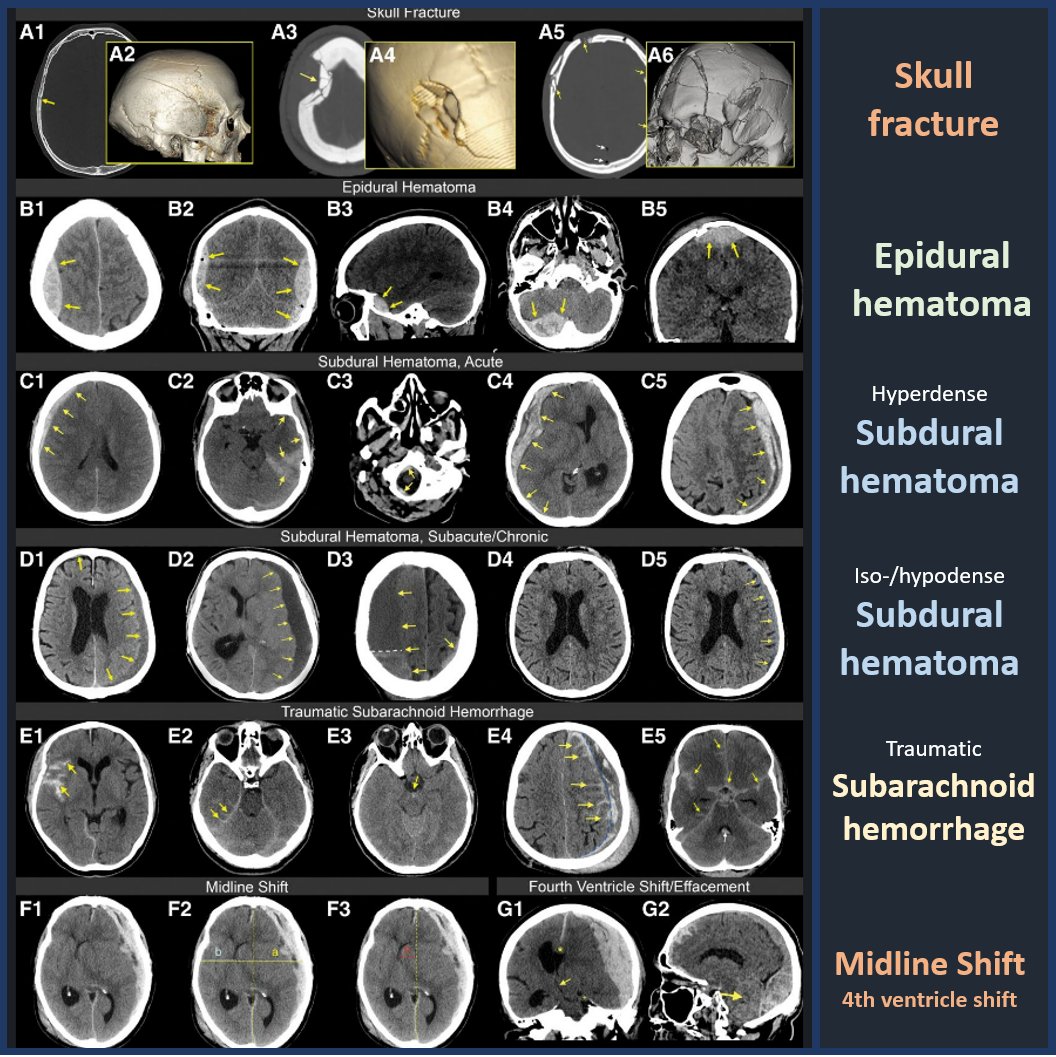 Glad to have been included in this briljant paper by @t_vandevyvere on imaging of traumatic brain injury. Just look at these figures, he got the arrows right and everything ;)! Check out the paper here: liebertpub.com/doi/10.1089/ne… #neurorad #radres #FOAMed #MedEd #FOAMrad #radiology