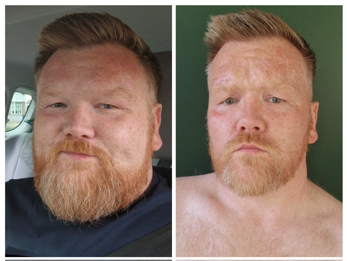 The picture on the left was taken less than a year ago. I was drinking so much that I couldn't cope with the lack of action and accountability after the Shannon report was published. The picture on the right was taken just now. It's been a hard 10 months. #TherapyWorks #SoberLife