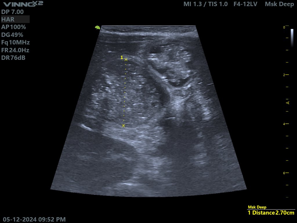 EchoTech_4's tweet photo. 6month male patient presented with yellow like vomiting and absolute constipation since 1.5 days 

Your Opinion?

#Echo_Tich https://t.co/qOWLjq4XIb