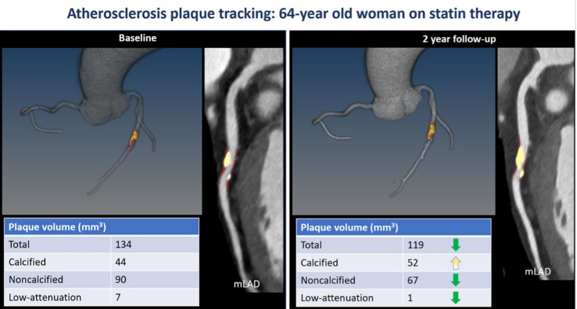 Rafał Wolny (@rafalwolny) on Twitter photo While the non-invasive characterization of atherosclerosis is rapidly evolving, it is my pleasure to share with you our hot-off-the-press review in Current Atherosclerosis Reports. Thank you <a href="/damini_dey/">Damini Dey</a> and all co-authors! Full text: rdcu.be/dHBVL While the non-invasive characterization of atherosclerosis is rapidly evolving, it is my pleasure to share with you our hot-off-the-press review in Current Atherosclerosis Reports. Thank you <a href="/damini_dey/">Damini Dey</a> and all co-authors! Full text: rdcu.be/dHBVL