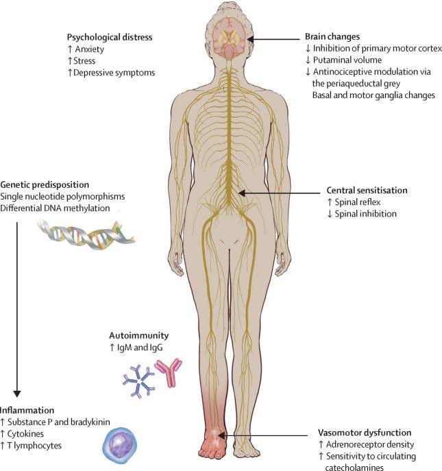 Nice illustration for the pathophysiology of Complex regional pain syndrome. A balanced - and early - pharmacological, neuromodulation, as well as physical and psychological approaches usually gives the best result. Nice new review: thelancet.com/journals/laneu… #CRPS