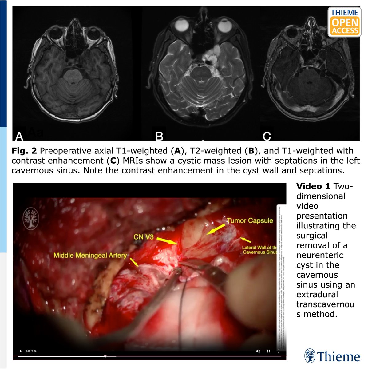 JNLSReports's tweet photo. 📢🆓#OpenAccessSunday
📽️Check out this #OperativeVideo of #GTR of a #CavernousSinus neurenteric cyst encasing the ICA via a #pterional craniotomy w/ an extradural transcavernous approach by @DrBaskaya &team:
https://t.co/8jzxsHnEx0
#JNLSR #skullbase #neurosurgery #otolaryngology https://t.co/52btOBEqhi