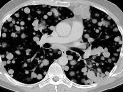 Patient with dyspnea and fever. Diagnosis?