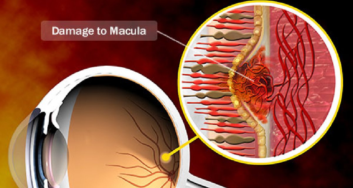 Macular degeneration affects more than 10 million Americans. It's the leading cause of vision loss. Here's what to know: wb.md/3wnPv2R
