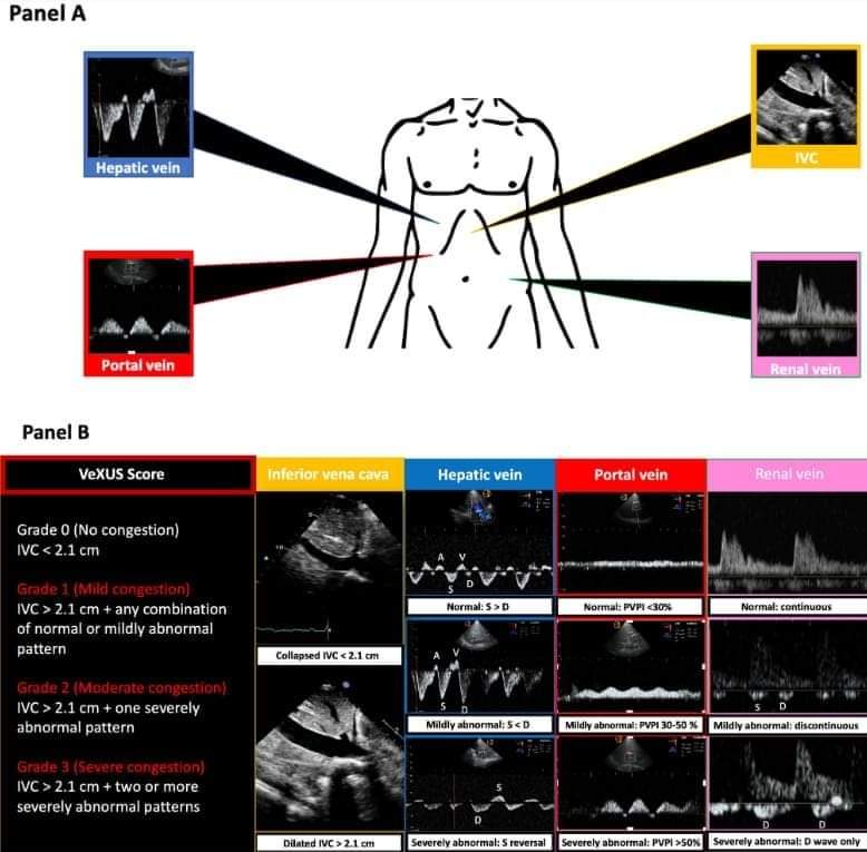 🔴 How to assess systemic venous congestion with point of care ultrasound 

academic.oup.com/ehjcimaging/ad…
#CardioTwitter #Cardiologia #cardiology #CardioEd #cardiotwiteros #medtwitter #meded #paramedic