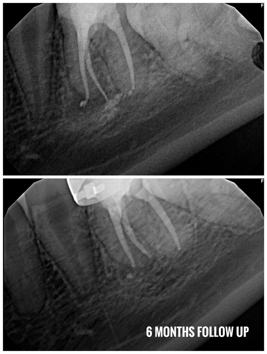 Not an easy case .. 
mesial canals calcified , i got one but the other end up with perforation and repaired with MTA 
- modifying the access to open the MB canal 😅  

Nice healing الحمدلله 👏🏼