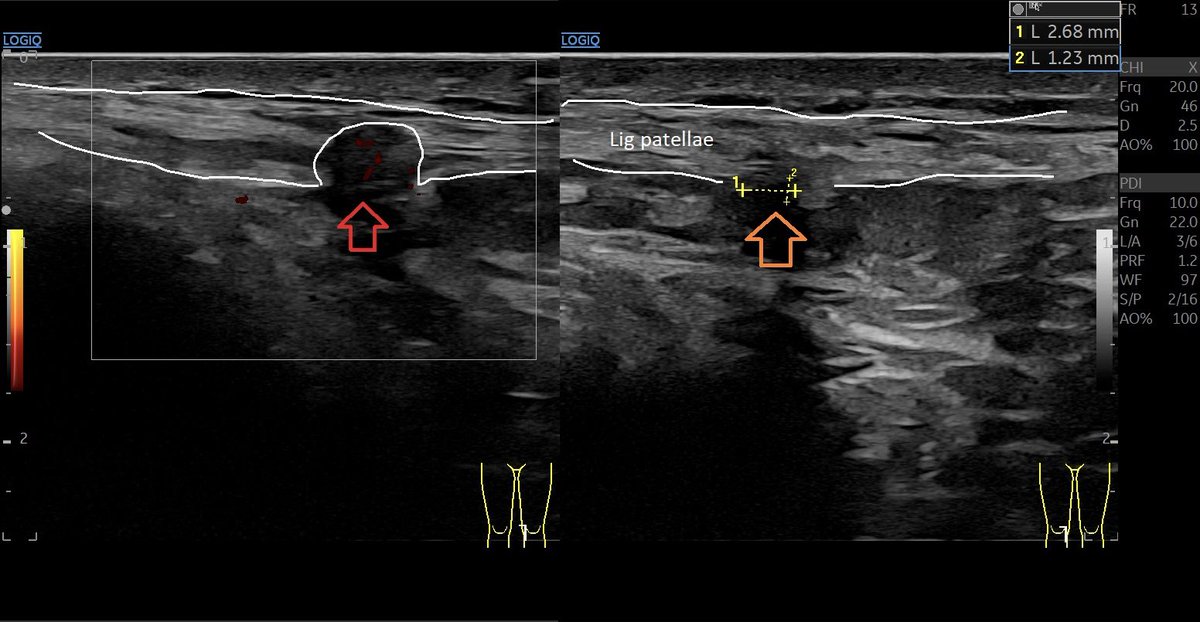 Symptomatic medial Hoffa impingement found with ultrasound palpitation #mskus #pocus #pocushub #GElogiqE10r3 #hoffaimpingement