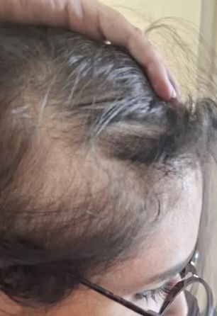 MarioNawfal's tweet image. OZEMPIC BUTT AND HAIR LOSS: TWO MORE SIDE EFFECTS EMERGE

Women using the weight-loss drug Ozempic are reporting shrinking backsides, known as "Ozempic butt," and increased hair loss.

Rapid weight loss from the drug leaves the skin sagging and reveals more bone structure,