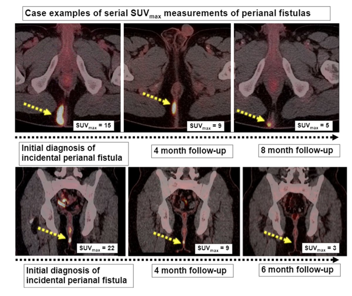 Pub alert: Evaluating Change in 18F-Fluorodeoxyglucose Uptake in Perianal Fistulas on PET/CT: A Serial Retrospective Analysis 🙌🎉 @DavidBallardMD for @radiology_rsna Research Scholar Grant to study #PETMR in #perianalCrohnsdisease academicradiology.org/article/S1076-… @AcadRadiol @SAR_IBD_DFP