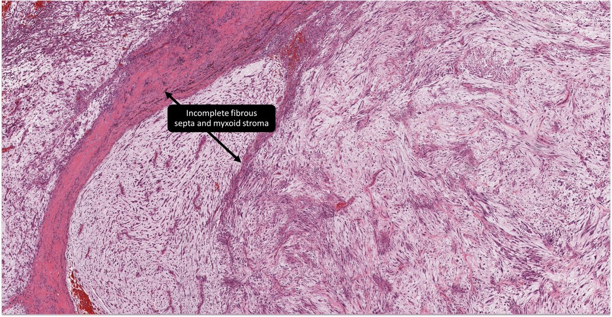 DrCycloPath's tweet photo. 65M thigh mass, diagnosis?
a) myxofibrosarcoma
b) myxoid liposarcoma
c) low grade fibromyxoid sarcoma
d) myxoid liposarcoma
#BSTPath #PathTwitter #Pathology #PathX https://t.co/G0wOBwSCFS