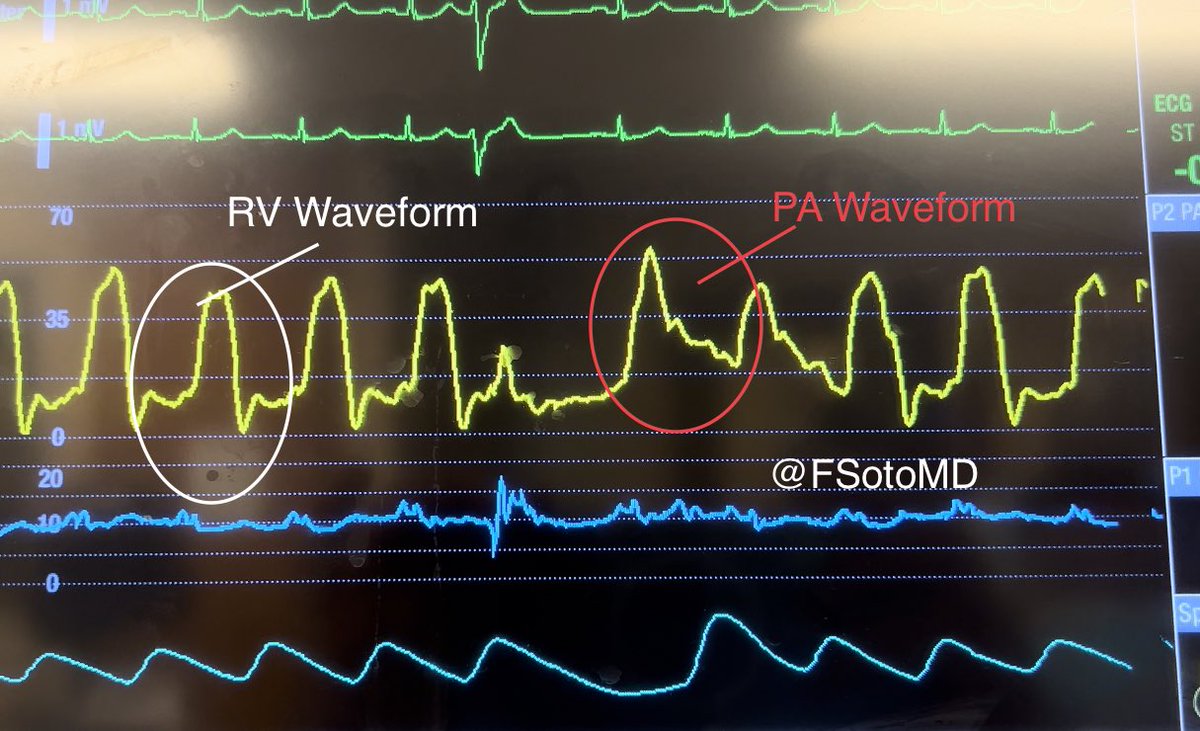 FSotoMD's tweet image. Hemodynamics and Right Heart Cath tweetorials collection. 
All in one place!

Threads: 
1. PA Catheter (PAC 101). The basics

2. Waveform recognition (PAC in ICU)

3. Quality control: 🔑troubleshooting before you use the data

4. Preventing the most dreadful PAC complication