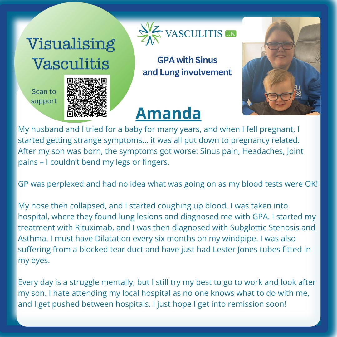 May - Day 20 #vasculitisawarenessmonth. Some types of ANCA #vasculitis present differently! Difficult to recognise, diagnose, difficult to treat & manage! Also life changing! #lung #nose #sinus #subglotticstenosis #asthma #tearduct Take a moment to read Amanda’s story!