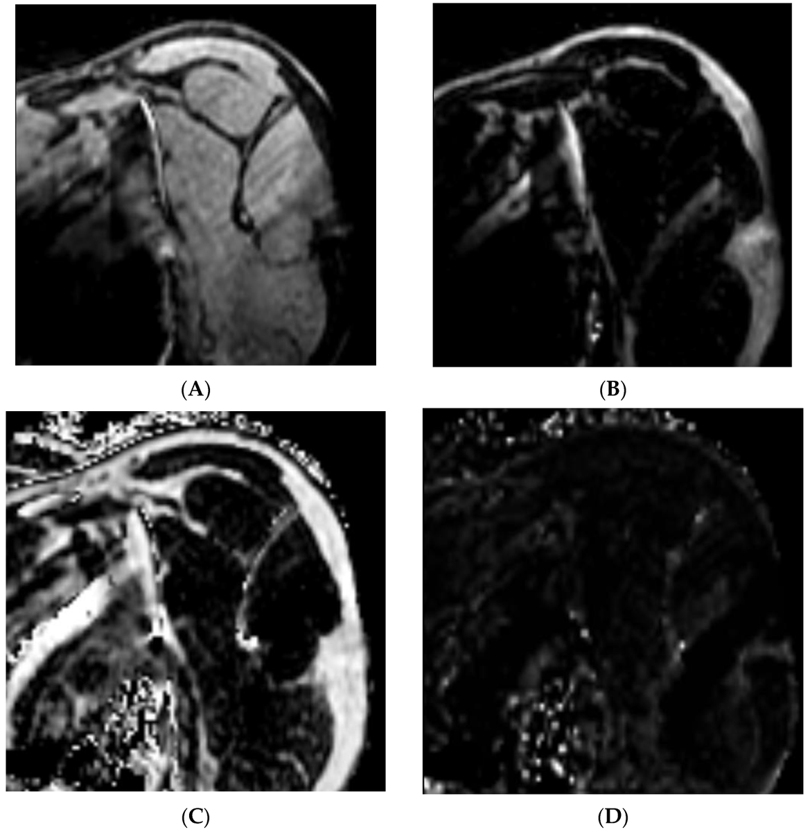 #NewPublication
💡The Use of Dixon Magnetic Resonance Imaging Methods for the Quantification of Rotator Cuff Fatty Infiltration: A Systematic Review 

mdpi.com/2813-0413/3/2/…

✍️by Andrew J. Nasr et al.
#MRI #shoulder #atrophy #MuscleDegeneration