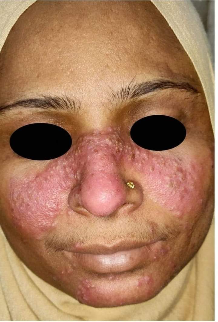 🟣𝘾𝙇𝙄𝙉𝙄𝘾𝘼𝙇 𝙎𝘾𝙀𝙉𝙀𝙍𝙄𝙊:-

A 40yr old female having characteristic rash over face.

What is your diagnosis ❓❓

#medx
#medEd