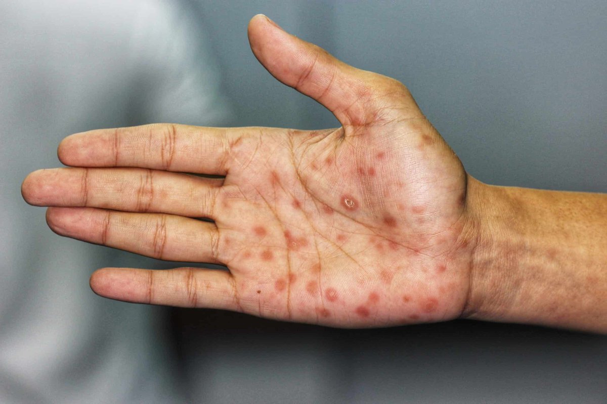 A 34-year-old man presents to the clinic with a rash on his hand. He is sexually active with multiple partners and does not use barrier contraception. Exam shown below. Diagnosis and treatment? Learn more and generate your own FREE board questions at neuralconsult.com 🧠