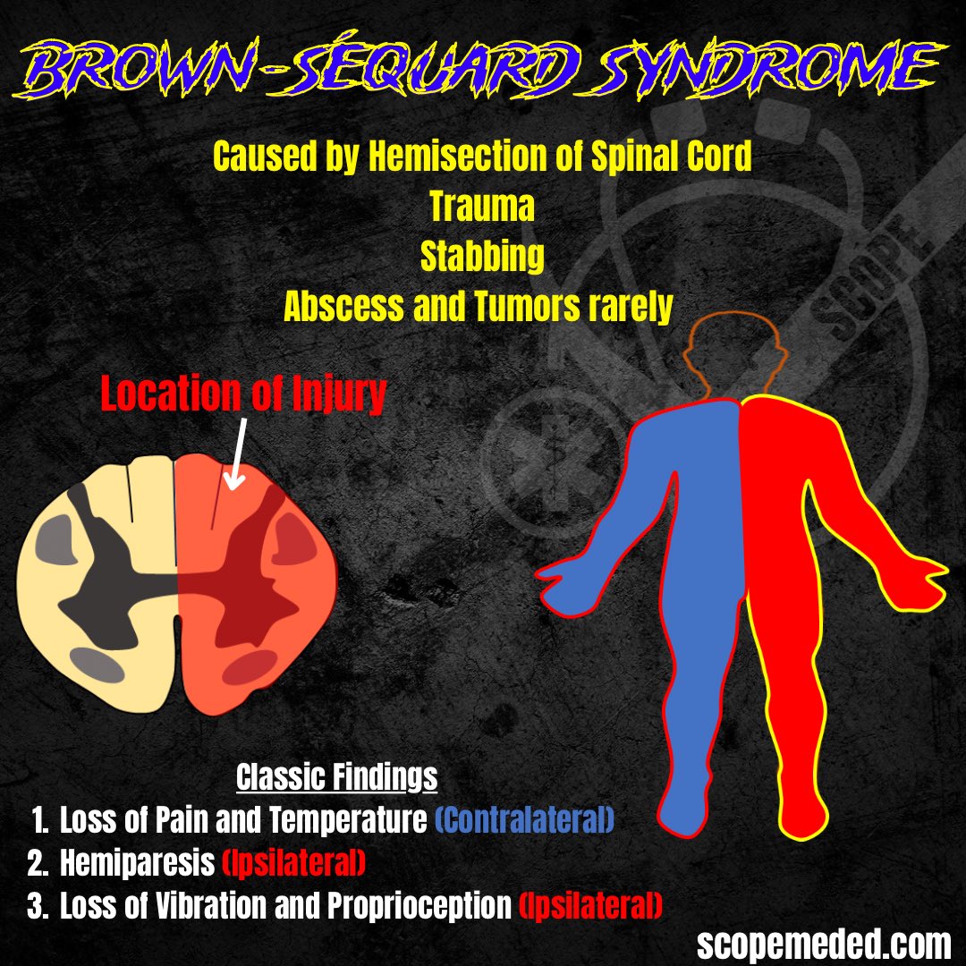 scopeducation's tweet photo. Brown-Sequard syndrome occurs due to hemisection of the spinal cord. Common causes include trauma, abscess/tumor.
Classic findings:
1️⃣ Loss of pain/temperature on the contralateral side
2️⃣ Hemiparesis on ipsilateral side 
3️⃣ Loss of vibration/proprioception on ipsilateral side https://t.co/BXSNQJNNSB