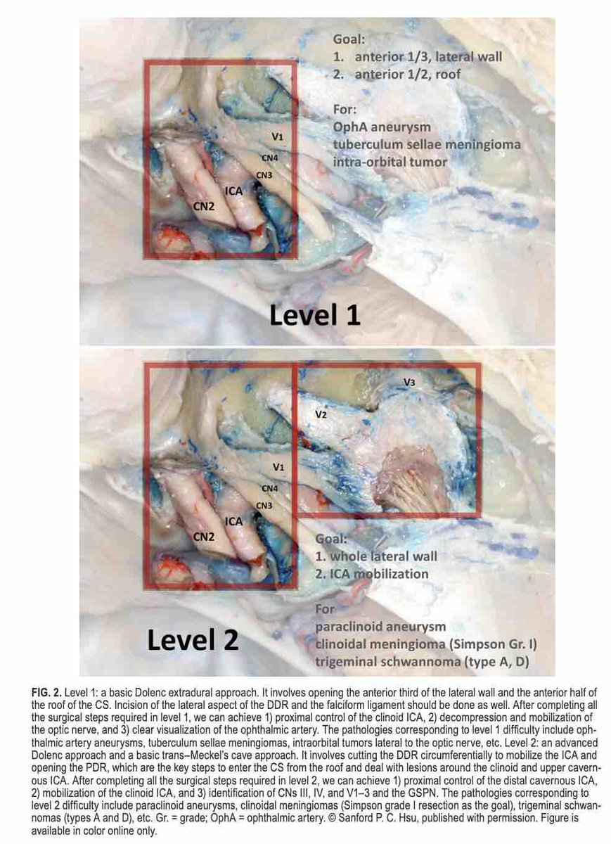 #OnlineFirst: The learning curve for cavernous sinus surgery illustrated by symptomatic intracavernous aneurysm clipping through a pretemporal transcavernous approach. thejns.org/view/journals/….