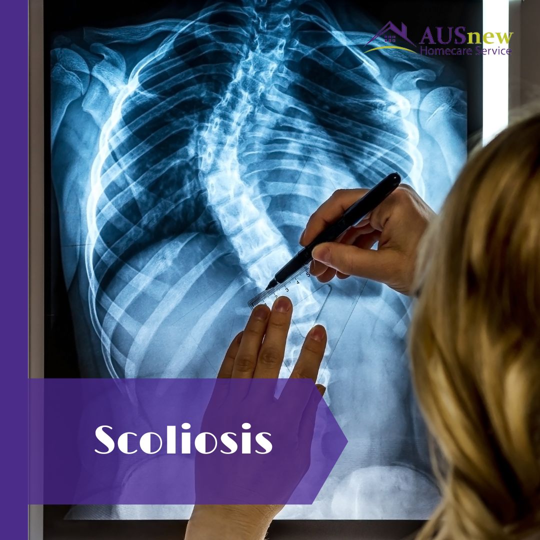 💫The most common age group to be diagnosed with scoliosis is adolescents. Although cerebral palsy and muscular dystrophy can cause scoliosis, most juvenile instances are undiagnosed. Source: Mayo Clinic #scoliosis #spinelateralcurvature