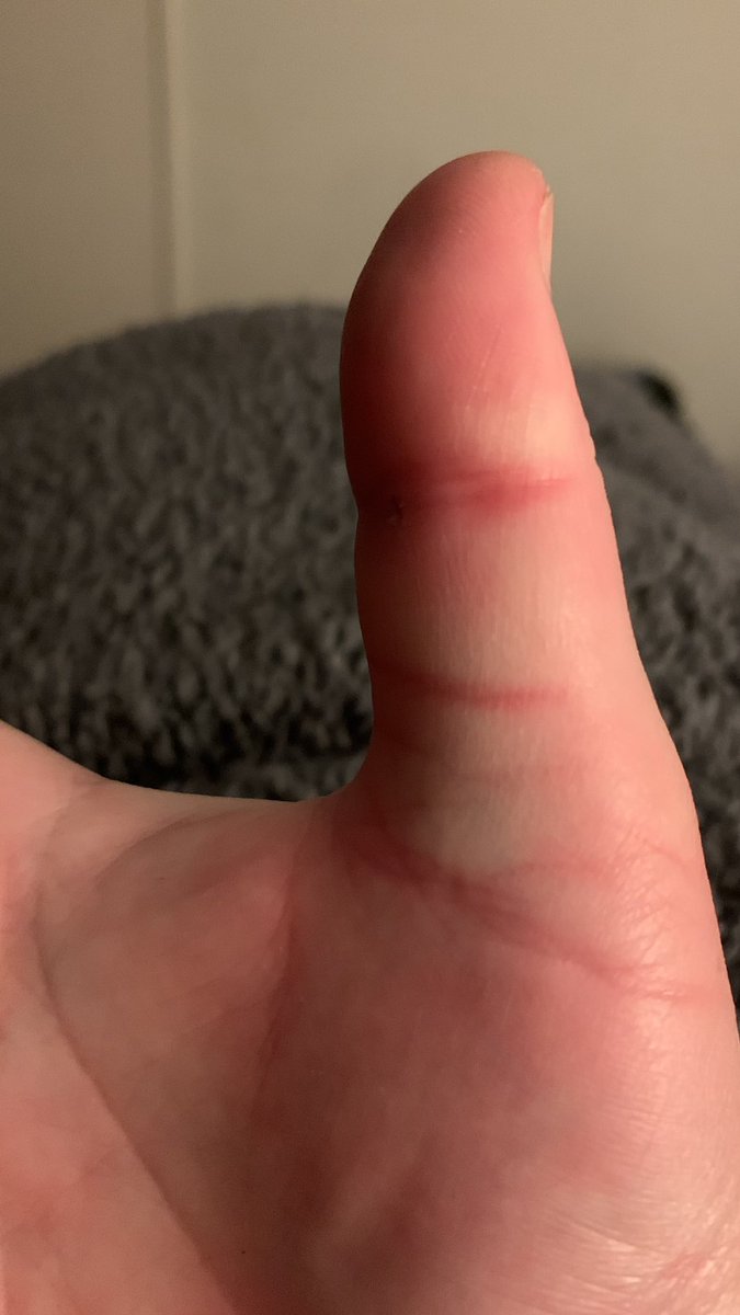 Derek my cat had a sort of seizure last night & bit me, totally out of character for him & only a very small puncture wound but this is my thumb tonight. I have been out in the sun so could be sunburn doesn’t hurt but then again it’s been numb for over a year anyway.