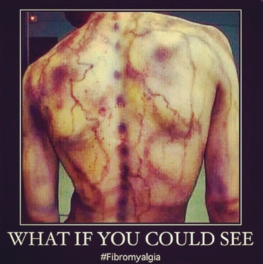 I live with Fibromyalgia an invisible disability that causes widespread pain, pretty much all the time. If fibromyalgia pain was visible, this is what you’d see #Fibromyalgia #FibromyalgiaAwarenessDay