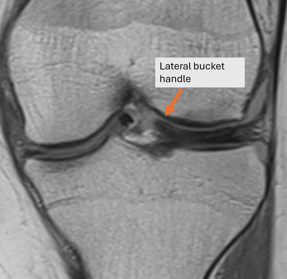 Double Trouble. Lateral and medial meniscus Bucket Handle Tear, in the setting of ACL rupture. Double PCL sign: MM bucket handle Double anterior horn sign: LM bucket handle