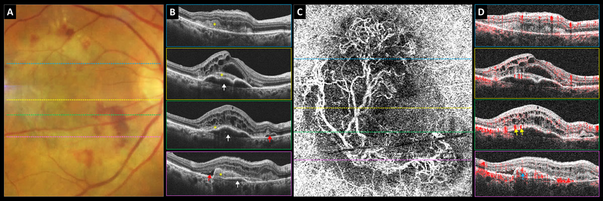 High-dose Aflibercept Pushes Dosing Interval to Five Months Nearly half of subjects went 20 weeks or longer between injections with the 8mg formulation. The regimen also maintained BCVA gains out to 96 weeks. reviewofoptometry.com/article/highdo… #eylea #amd #retina #eyecare #optometry