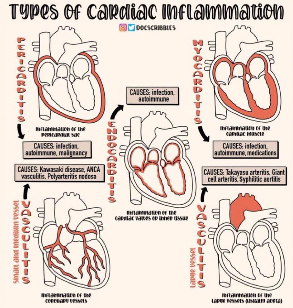 Types of cardiac inflammation 🫀 Cr. @DocScribbles #medtwitter @AlohaMeaveMD @erica_tirr